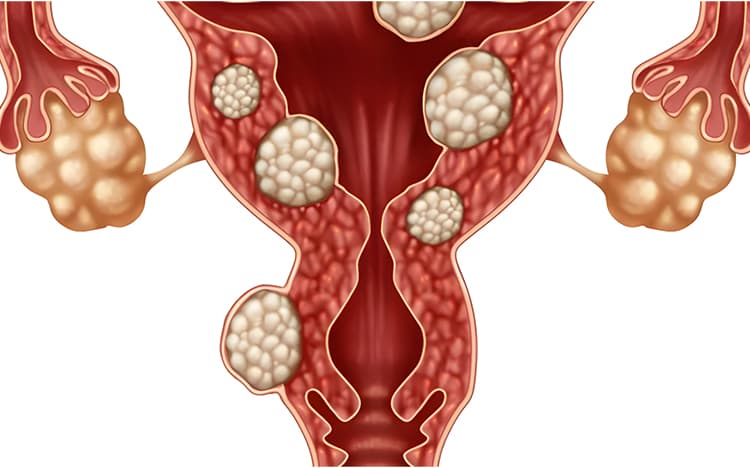 Fibromas uterinos