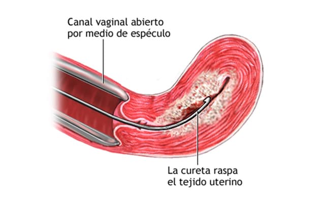 Dilatación y curetaje